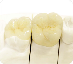 Couronne Full Emax + Inlay Céramique Emax